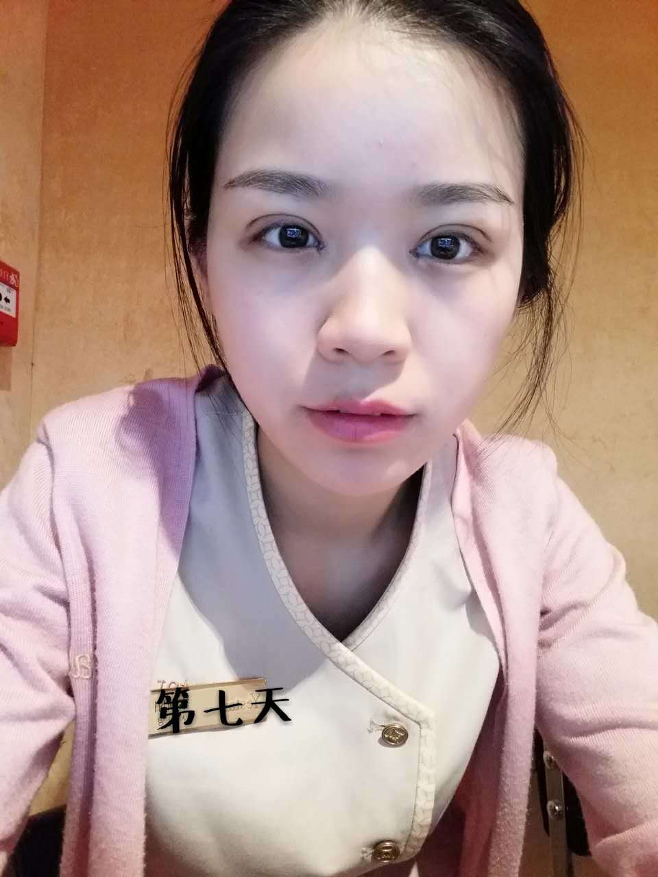 切开双眼皮第7天