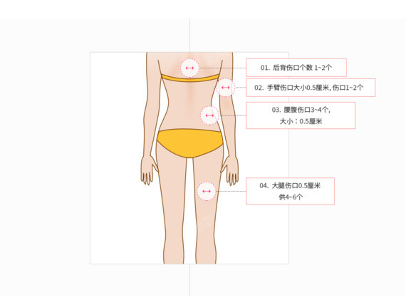 【吸脂】专业吸脂医院-360度手臂环吸