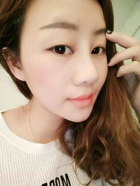 is追逐梦的孩子鼻综合第40天美丽日记-新氧美