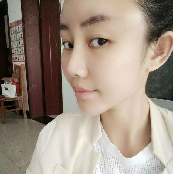 is追逐梦的孩子鼻综合第40天美丽日记-新氧美