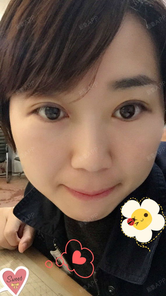 太原丽都整形美容医院埋线双眼皮第7天美丽日