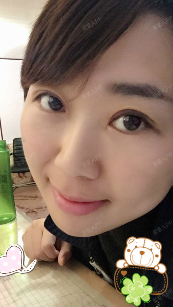 太原丽都整形美容医院埋线双眼皮第7天美丽日