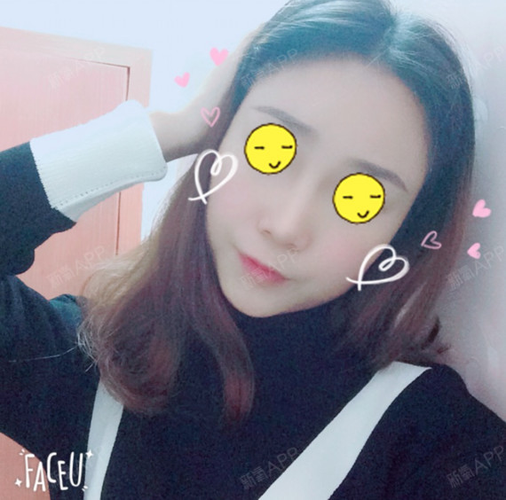 第四人称的鼻综合第68天美丽日记-新氧美容整