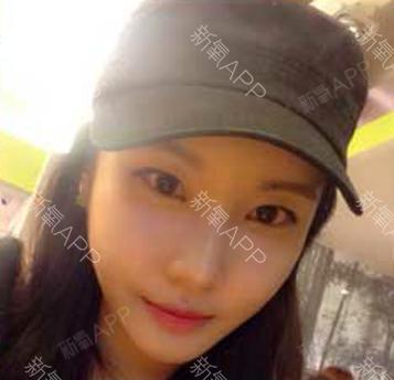 如果还有梦自体脂肪全脸填充第45天美丽日记