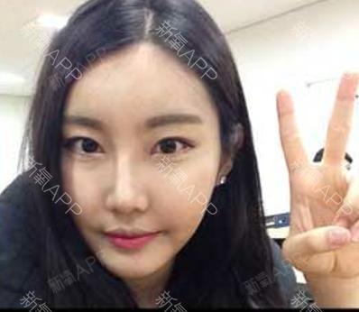 如果还有梦自体脂肪全脸填充第20天美丽日记