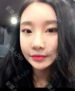 如果还有梦自体脂肪全脸填充第45天美丽日记