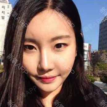 如果还有梦自体脂肪全脸填充第45天美丽日记