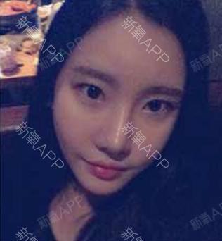 如果还有梦自体脂肪全脸填充第45天美丽日记