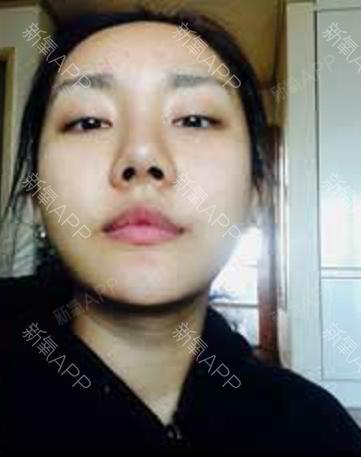 如果还有梦自体脂肪全脸填充第10天美丽日记