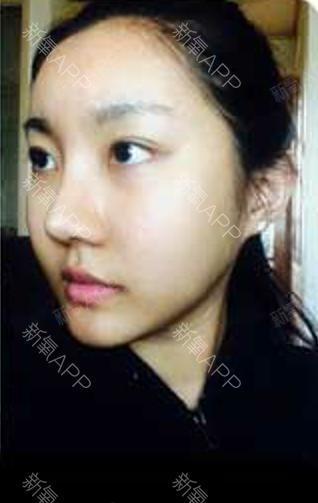 如果还有梦自体脂肪全脸填充第10天美丽日记