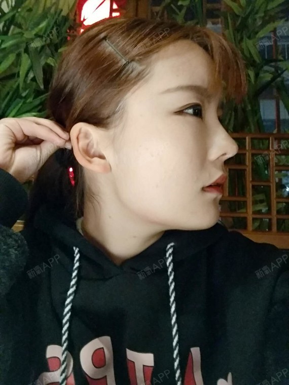 阁楼里的小花F鼻综合第125天美丽日记-新氧美