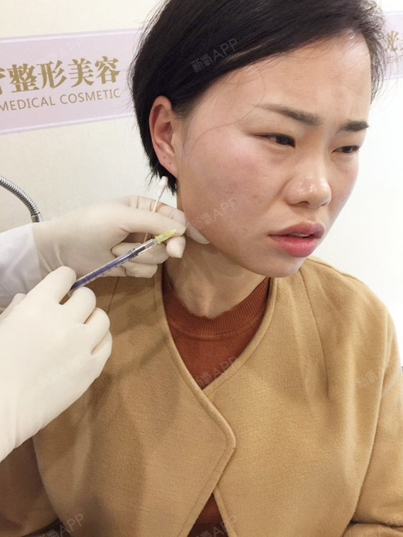 丶迩若不离丶莪便不弃溶脂针瘦脸术后第天美丽日记