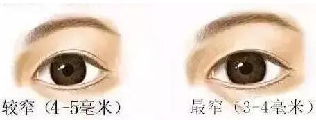 案例详说:双眼皮宽度形态设计,看看你适合哪一种?