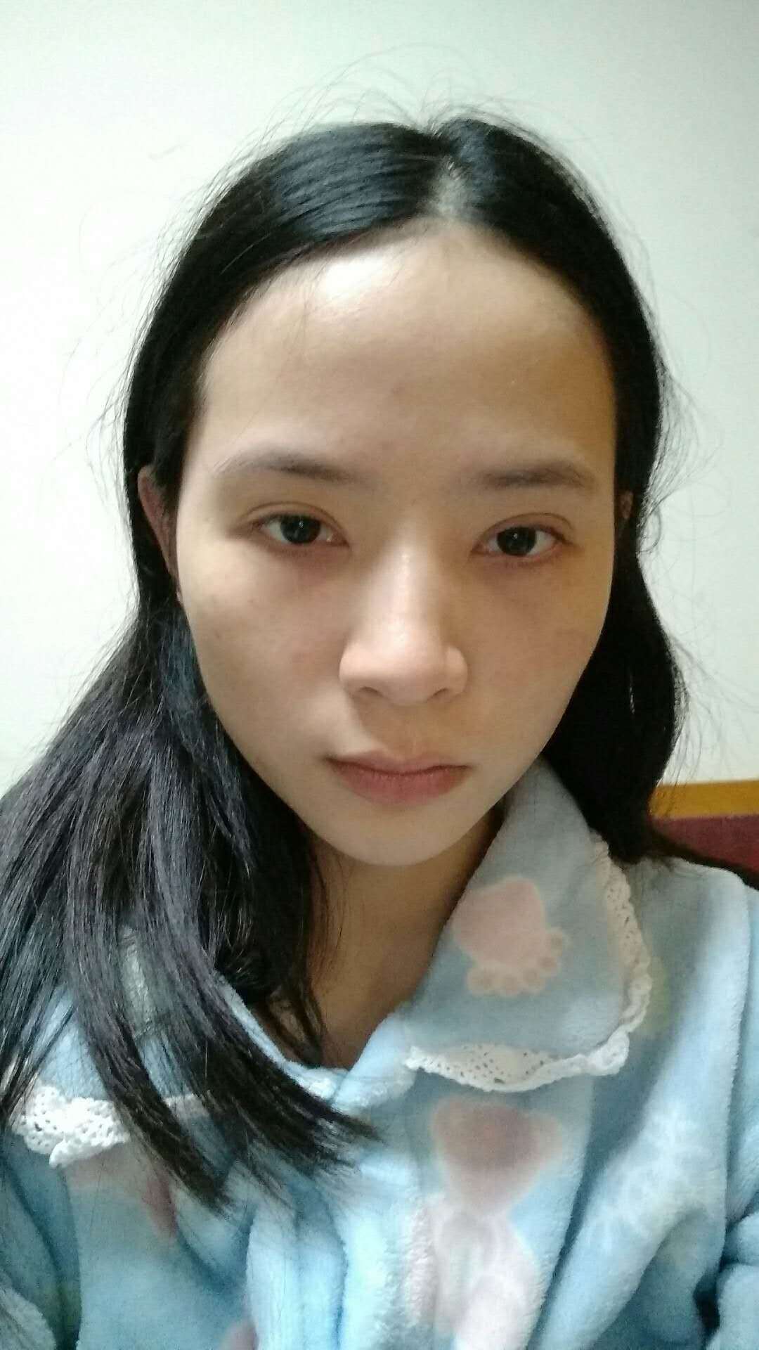 成都医美整形外切去眼袋怎么样_恢复过程_效果如何_10