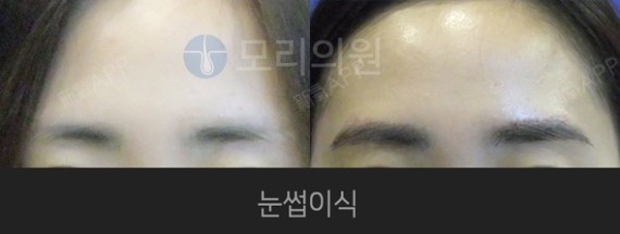 {韩国毛理医院-眉毛移植手术特点!}20多岁的大