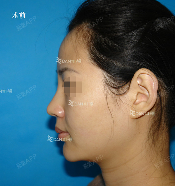 【取鼻部人工骨粉后做鼻综合案例】鼻部骨粉取出后行膨体隆鼻,鼻头