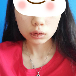 【深圳南西子厚唇改薄】今天终于去给我的厚嘴唇给做了手术啦,之前老
