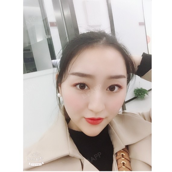 wy柚子多肉玻尿酸垫下巴第93天美丽日记-新氧