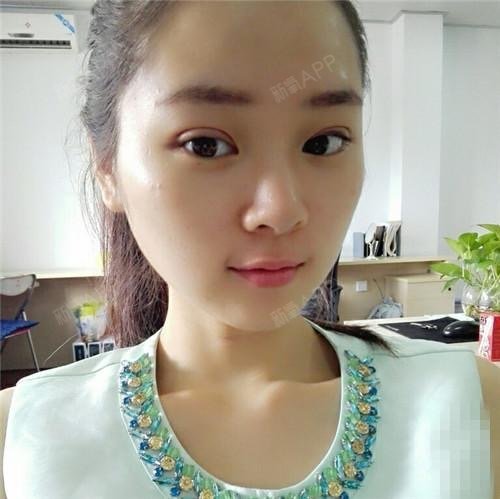 咪咪倪妮定点双眼皮第7天美丽日记-新氧美容整