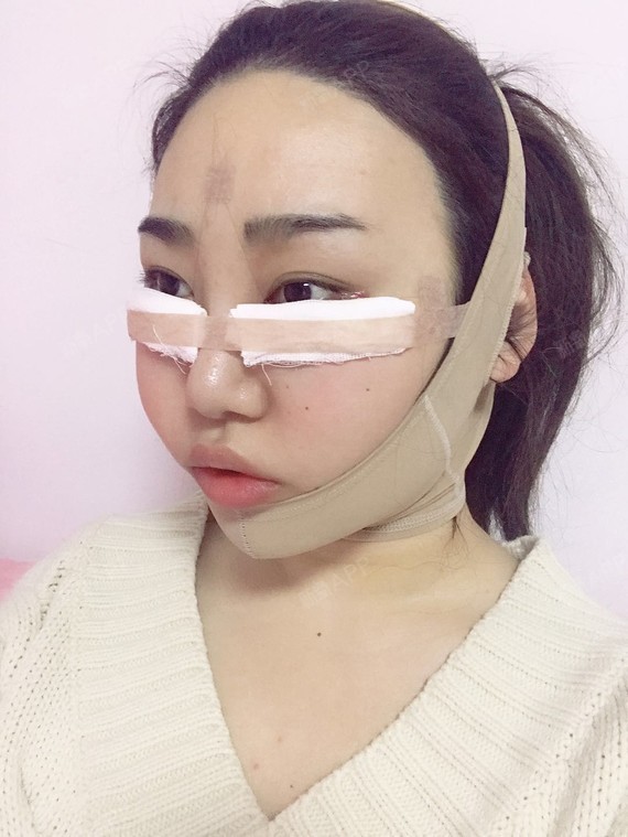 内切去眼袋