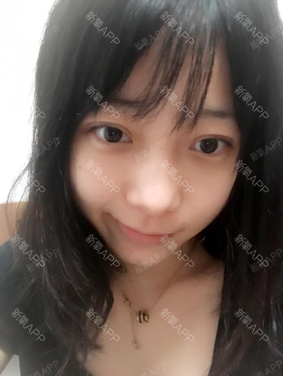 lody甜圈圈切开双眼皮第7天美丽日记-新氧美容