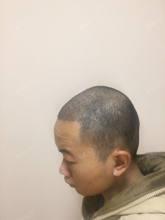 美人尖种植