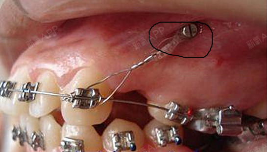 广州圣贝牙科------正畸时打骨钉的作用