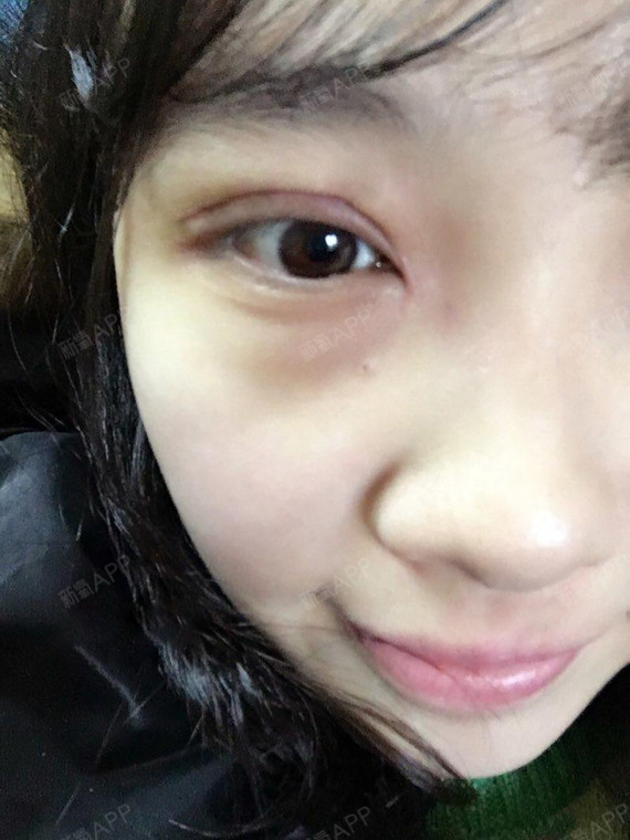 我是一个大美女切开双眼皮第0天美丽日记-新氧