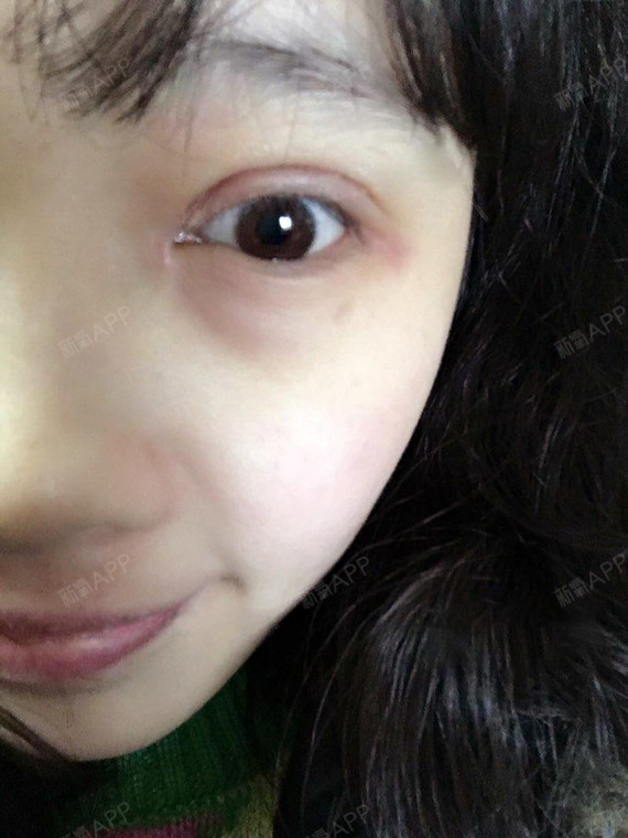 我是一个大美女切开双眼皮第0天美丽日记-新氧