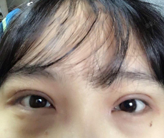 我是一个大美女切开双眼皮第0天美丽日记-新氧