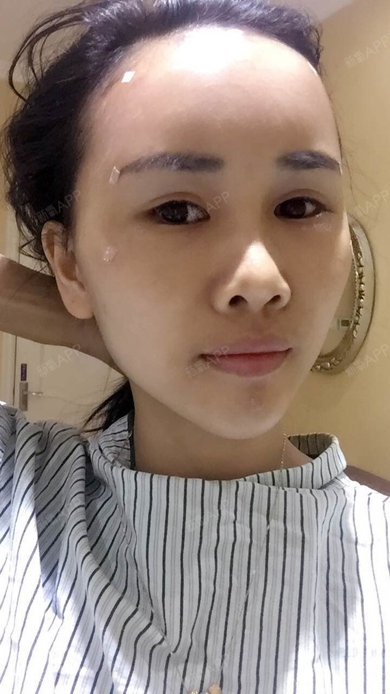 新氧- 小团子小 | 自体脂肪填充额头 | 自体脂肪填充太阳穴 | 自体