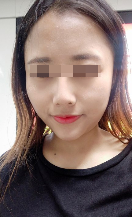 屌丝飞车党czfu鼻综合第15天美丽日记-新氧美