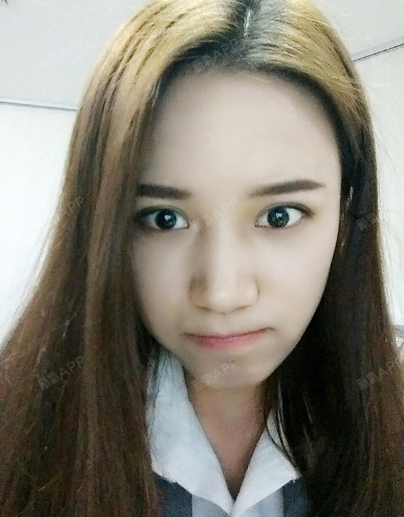 张珊_783324自体脂肪全脸填充第113天美丽日记