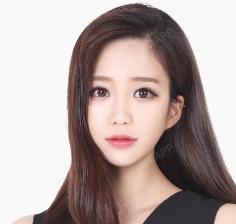 【韩国TS整形外科医院】双向开眼角的后加,1