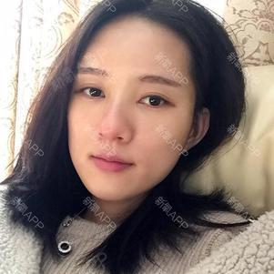 十年约续梦自体脂肪全脸填充第10天美丽日记