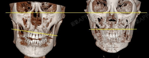 【不对称矫正-双鄂手术】