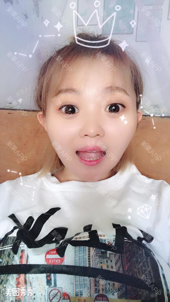 珍妮的故事玻尿酸垫下巴第7天美丽日记-新氧美