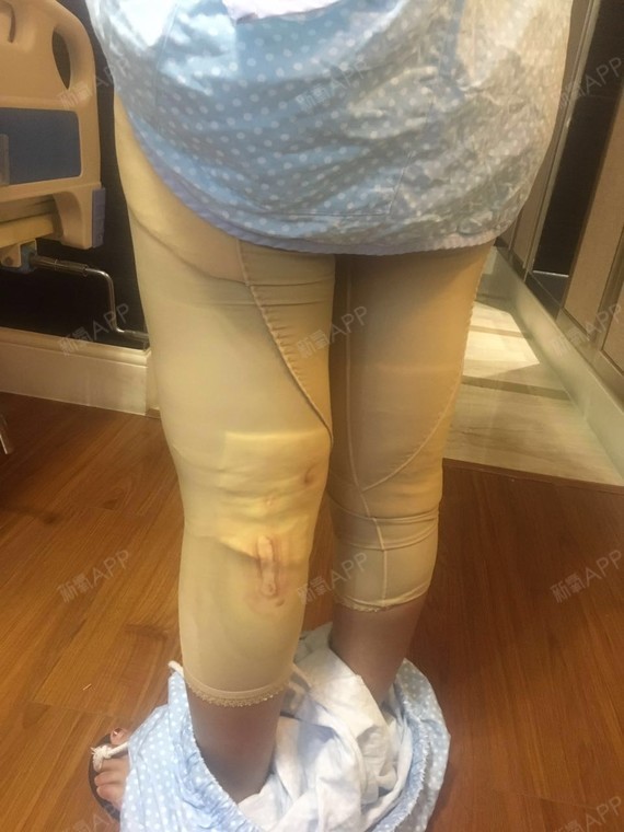下面是手术之后第三天的照片.你们看效果.