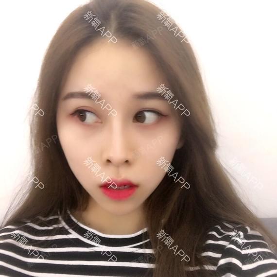 陈向荣鼻综合第62天美丽日记-新氧美容整形