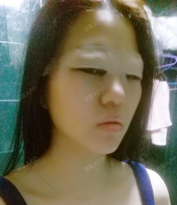 1赶紧十八我要娶她开内眼角第1天美丽日记-新