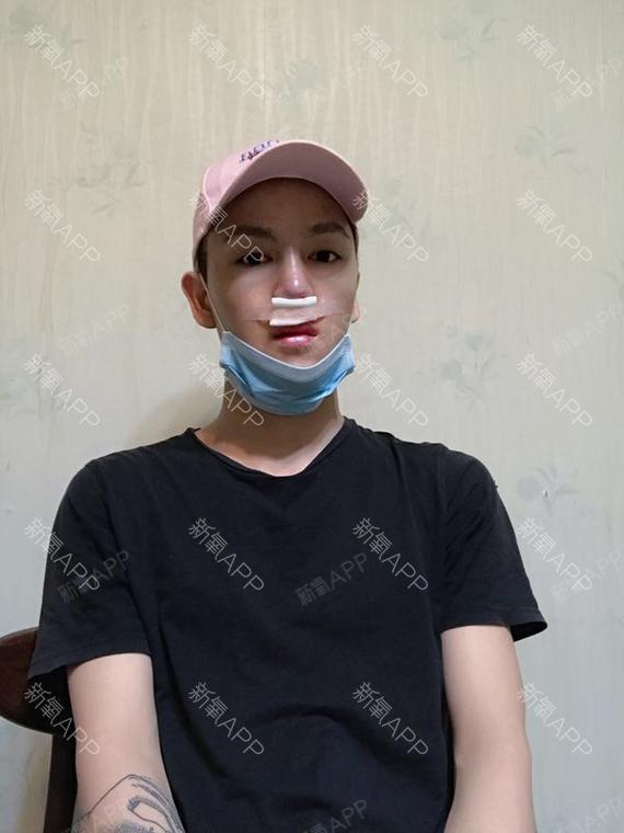 到院之后咨询,了解了假体隆鼻,然后就是选择假