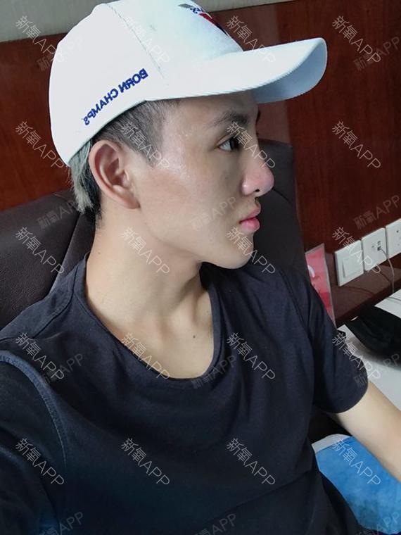 到院之后咨询,了解了假体隆鼻,然后就是选择假