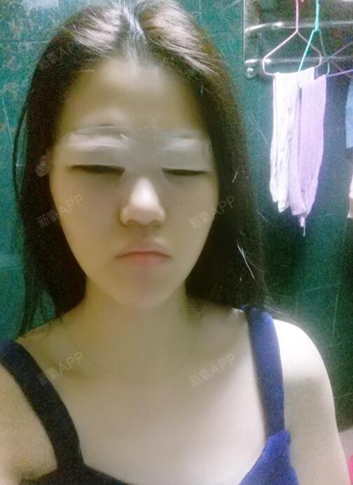 1赶紧十八我要娶她开内眼角第1天美丽日记-新