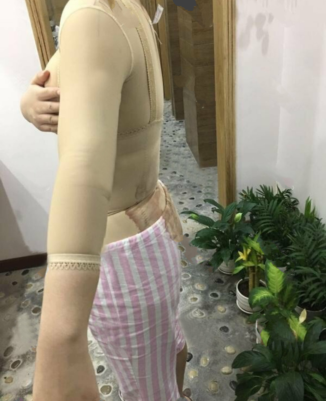 吸脂瘦手臂第1天