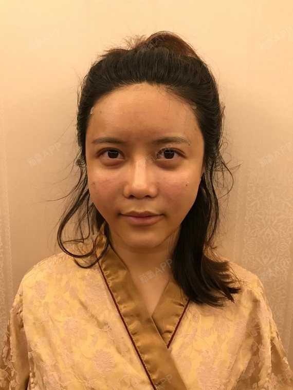 上个月我做了自体脂肪填充,今天是第33天,我以前脸上没有肉,颧骨高,看