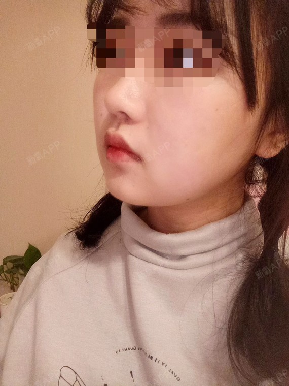 大风吹揍谁光纤溶脂瘦脸第7天美丽日记-新氧美