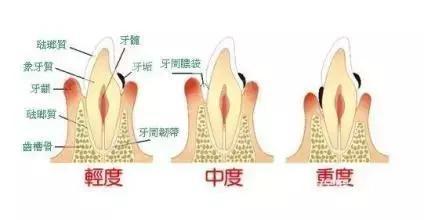 咬合力量不协调,导致牙周发生损伤,从而导致了牙龈萎缩产生黑三角