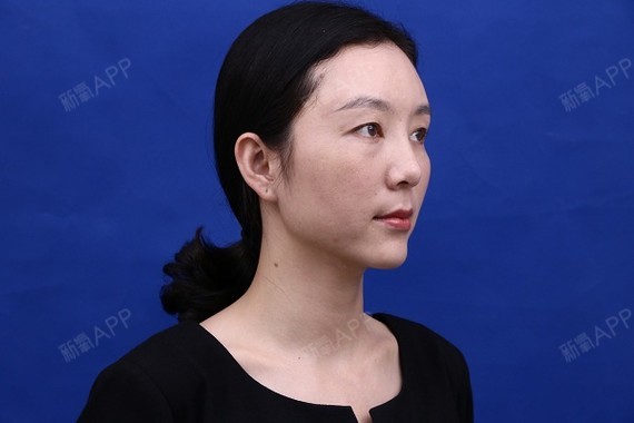 tamny自体脂肪全脸填充第24天美丽日记-新氧美