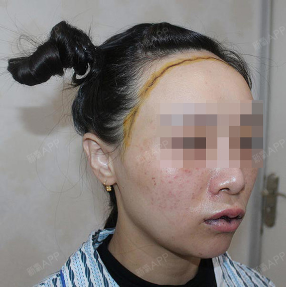 #种植发际线术前设计中#头发种植是为永久性