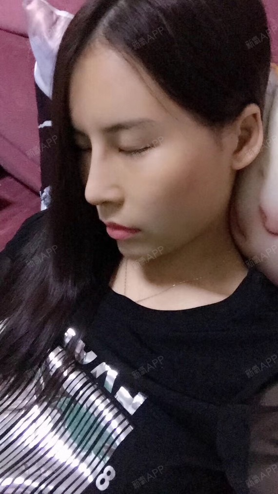 【长沙希美小直鼻,膨体垫鼻基底术后45天】
